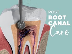 Tips for Caring for Your Root Canal Post Op