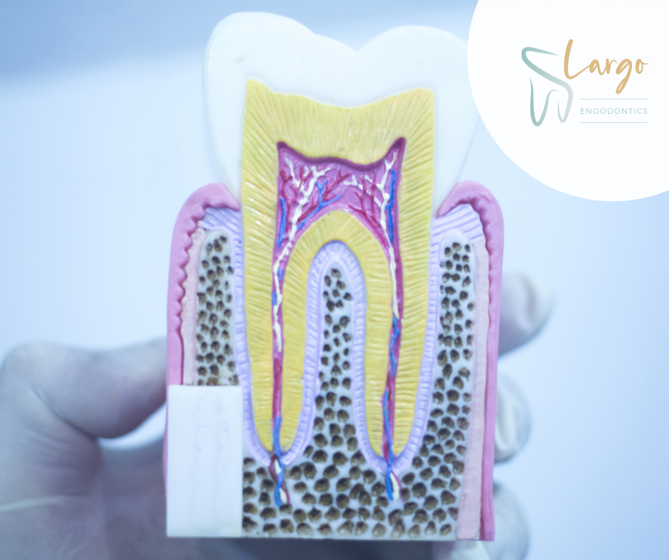 5 Common Reasons Why a Root Canal Fails